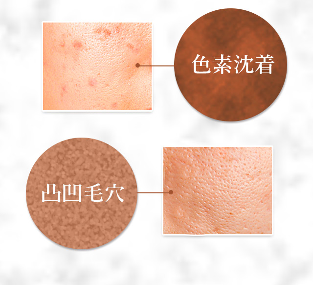色素沈着 ぶつぶつ毛穴