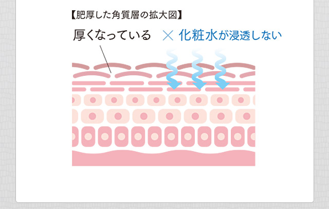 肥厚した角質層の拡大図