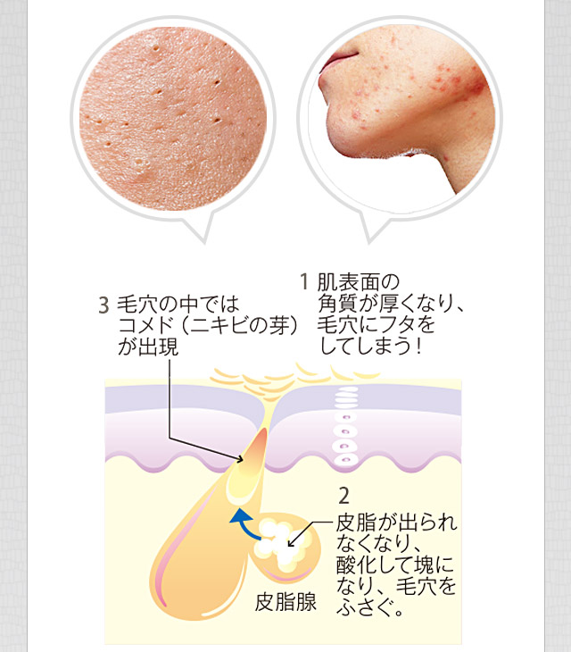 1角質が厚くなり毛穴にフタをする 2皮脂が出られなくなり酸化して毛穴をふさぐ 3毛穴の中に角栓ができる