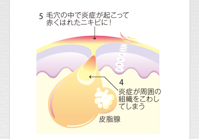 4炎症が周囲の組織を壊す　5毛穴の中で炎症が起こって赤く腫れたニキビに！